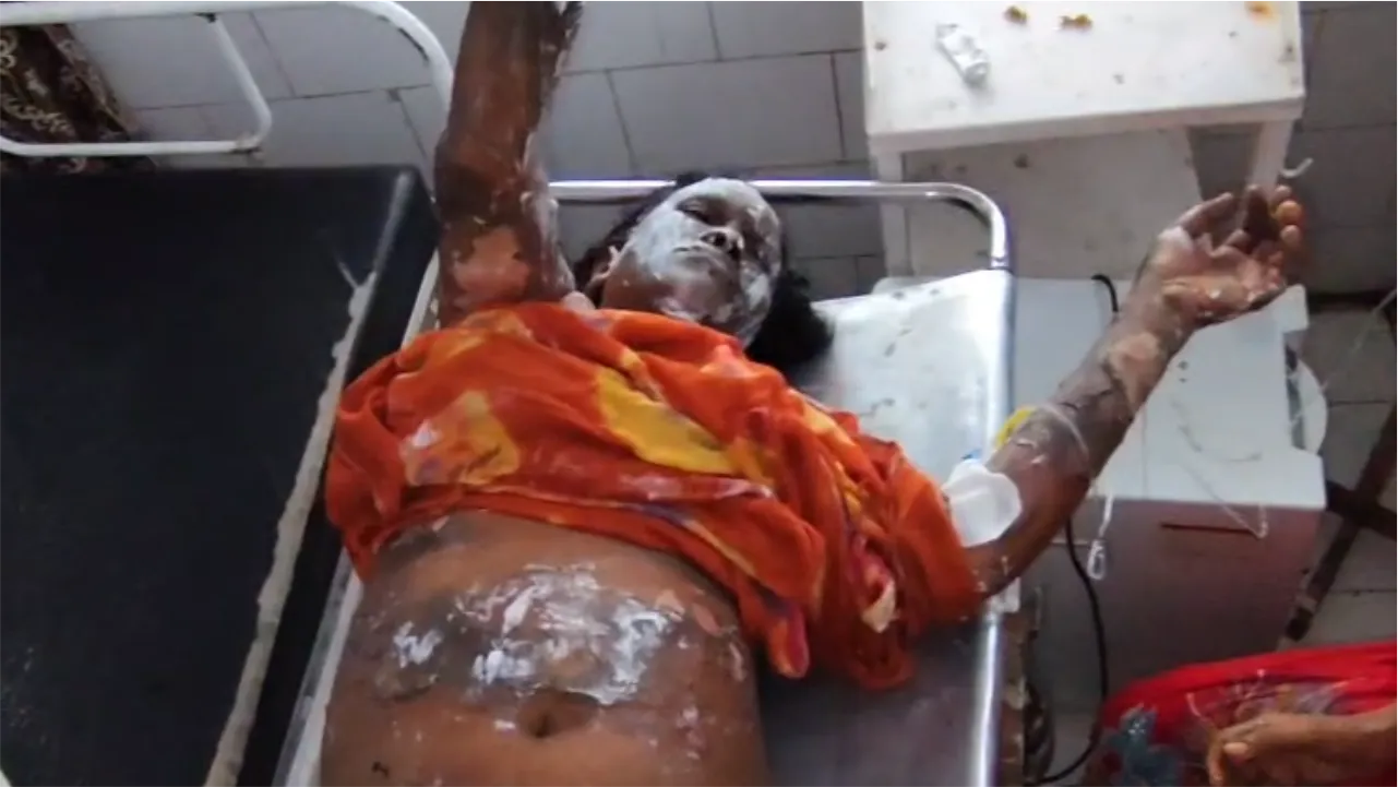 मंदसौर में बिजली ग्रिड पर महिला के आत्मदाह का मामला, इलाज के दौरान मौत, बिजली चोरी के पंचनामे को लेकर हुआ था विवाद